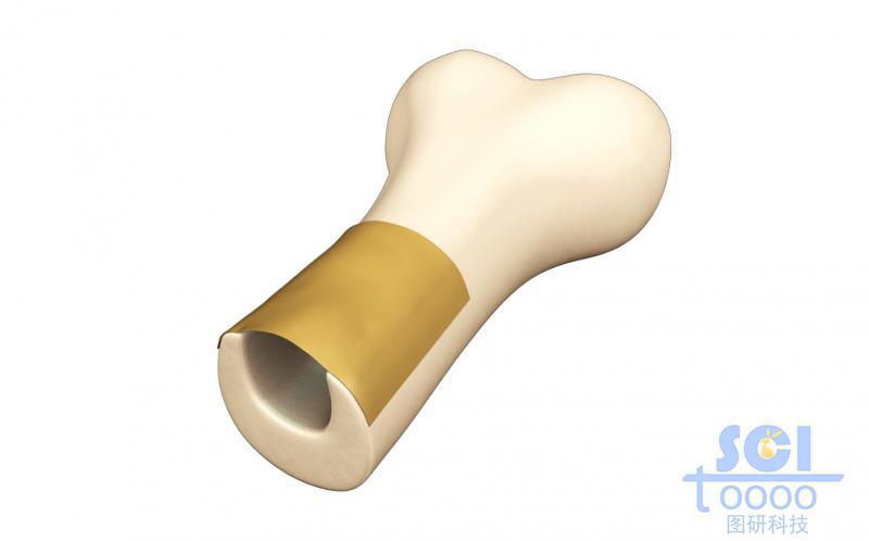 前段帶切口骨骼